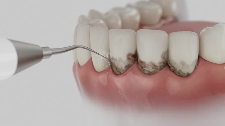 Reliable Tooth Extraction contractor in Hudson, CO by Smile Center Dentistry